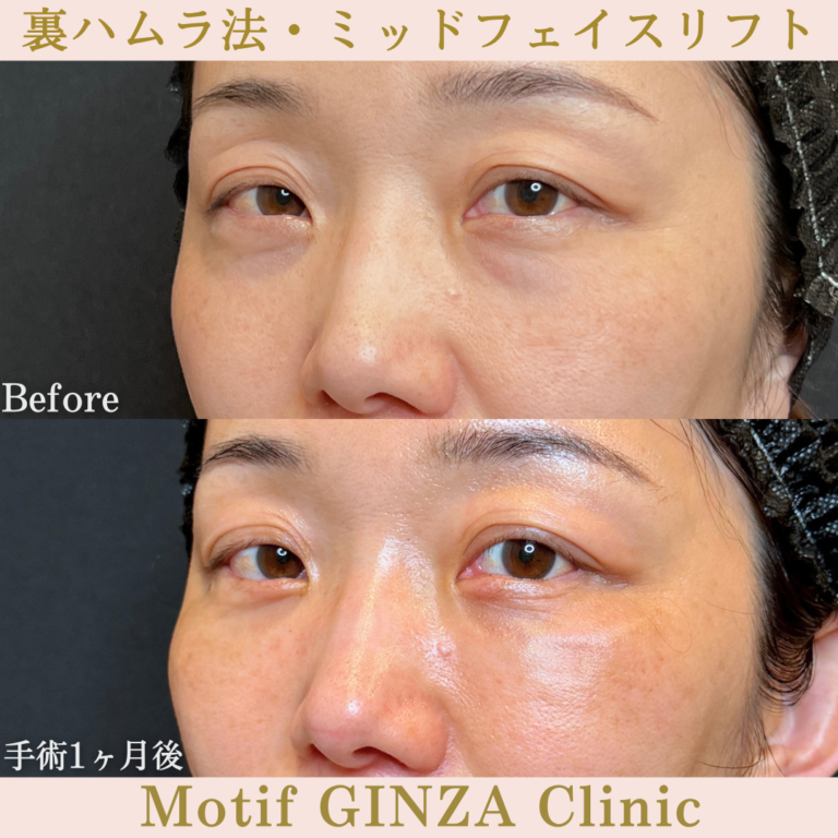裏ハムラ法・ミッドフェイスリフト(手術3か月)の写真4