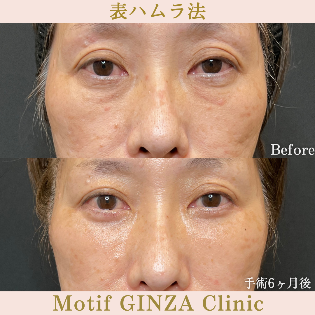 切開式下眼瞼たるみ取り（手術６か月）の写真