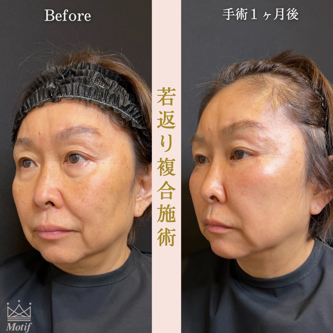 若返り複合施術（手術３ヶ月）の写真4