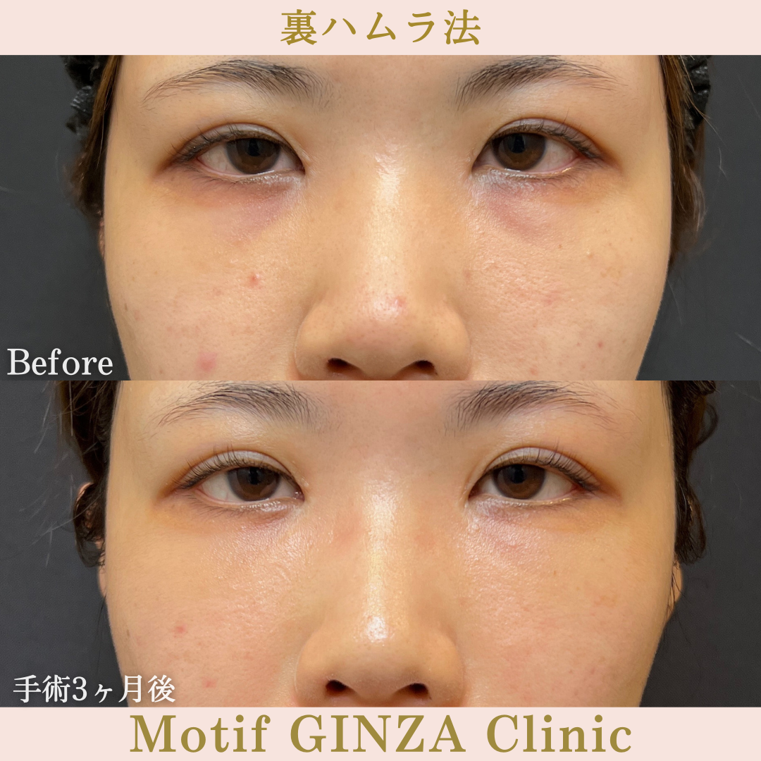 裏ハムラ法(手術3ヶ月)の写真1