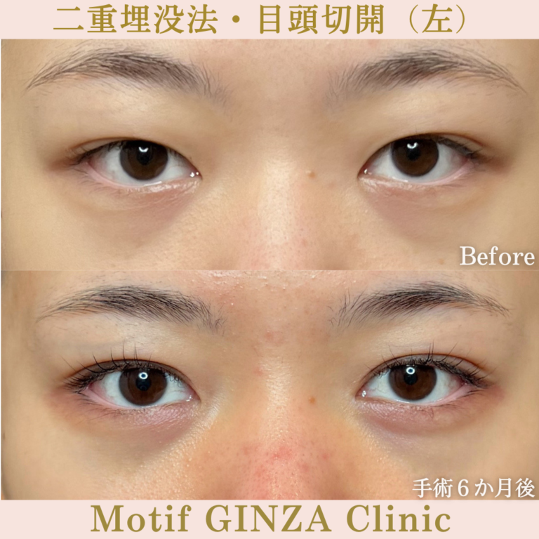 二重埋没法・目頭切開（手術6か月）