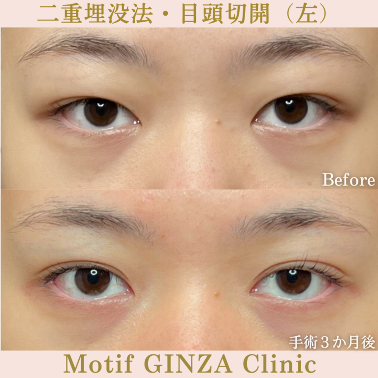二重埋没法・目頭切開（手術３か月）