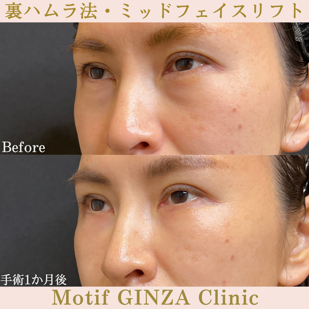裏ハムラ法・ミッドフェイスリフト（手術１年）の写真6