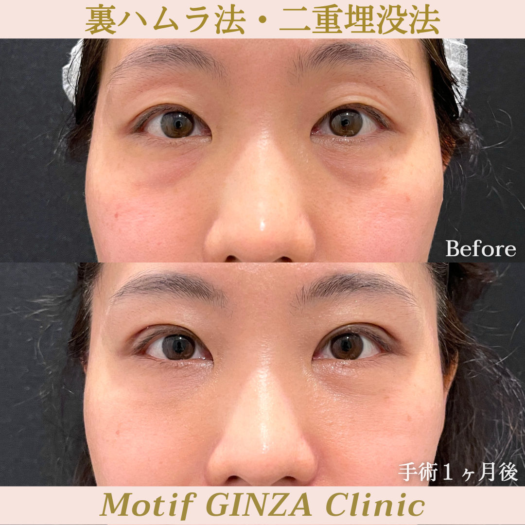 裏ハムラ法・二重埋没法（手術１ヶ月）の写真