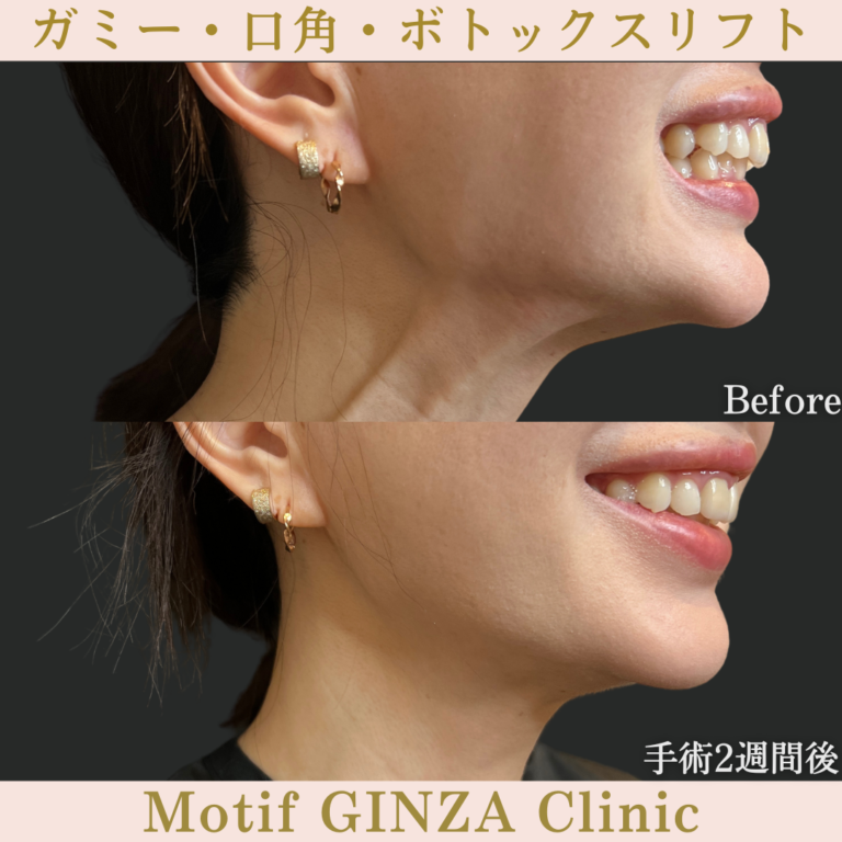 ガミー・口角・ボトックスリフト(手術2週間)の写真2