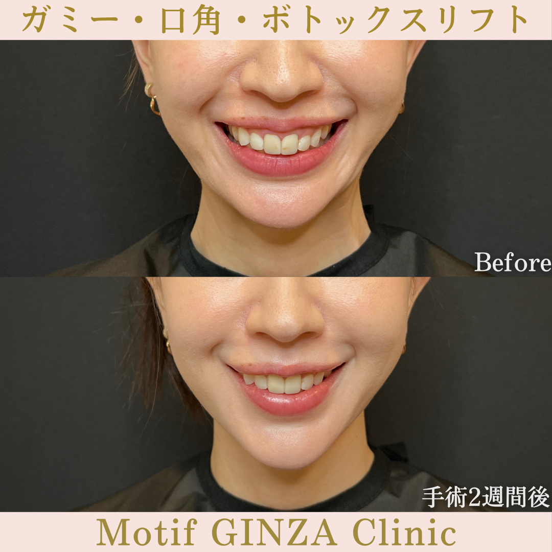 ガミー・口角・ボトックスリフト（手術２週間）の写真