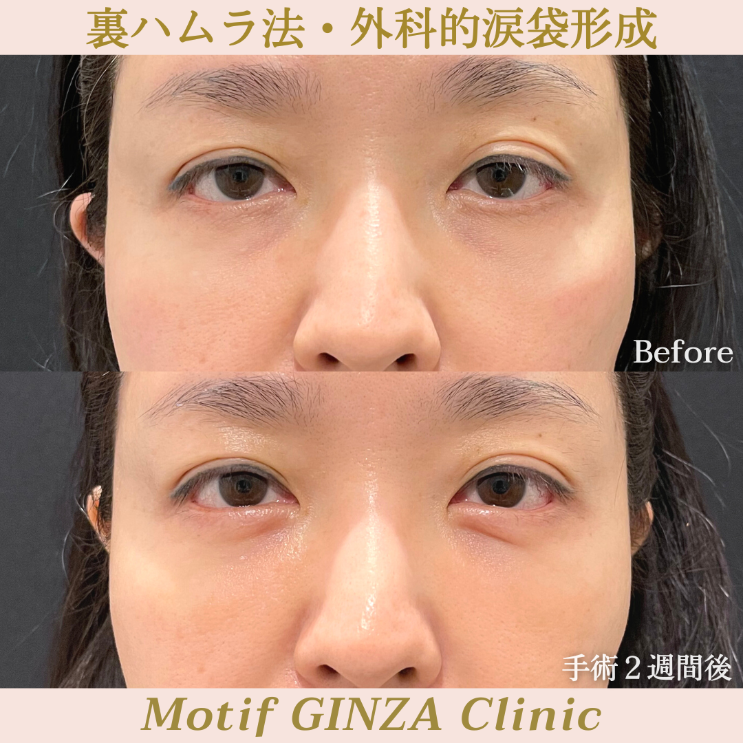 裏ハムラ法・外科的涙袋形成(手術3ヶ月)の写真4