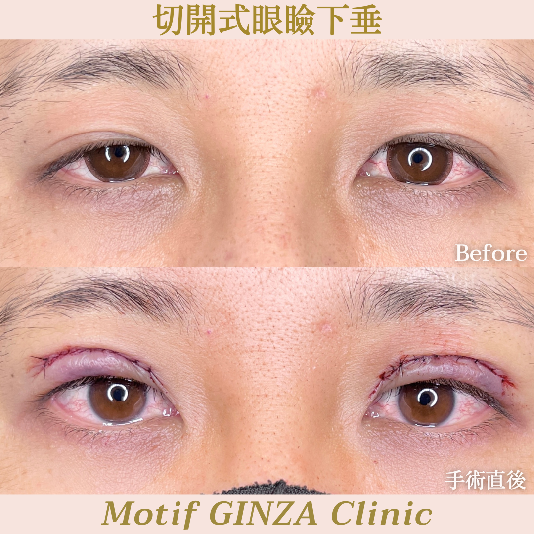 切開式眼瞼下垂手術（手術３ヶ月）の写真5
