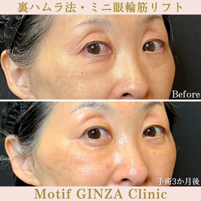 裏ハムラ法・ミニ眼輪筋リフト（手術3か月）の写真2