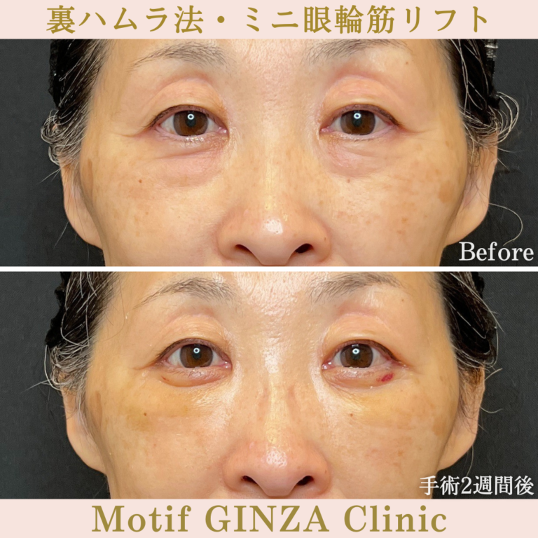 裏ハムラ法・ミニ眼輪筋リフト（手術1か月）の写真3