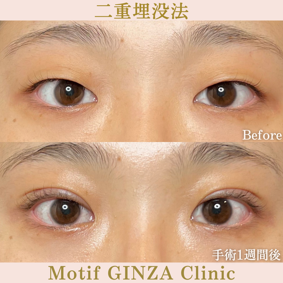 二重埋没法(手術1年後)の写真3