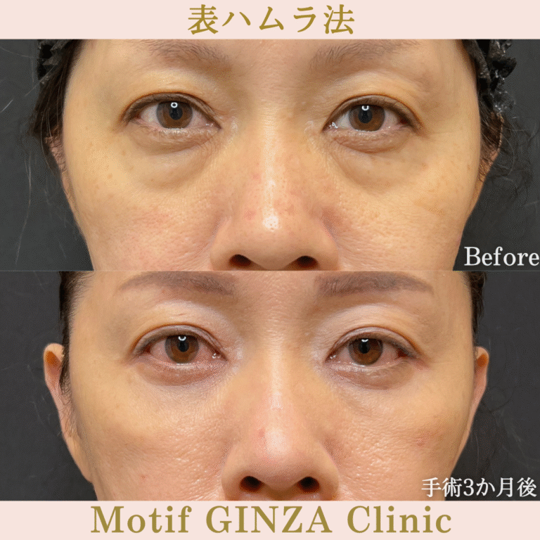 切開式下眼瞼たるみ取り（手術１年）の写真5