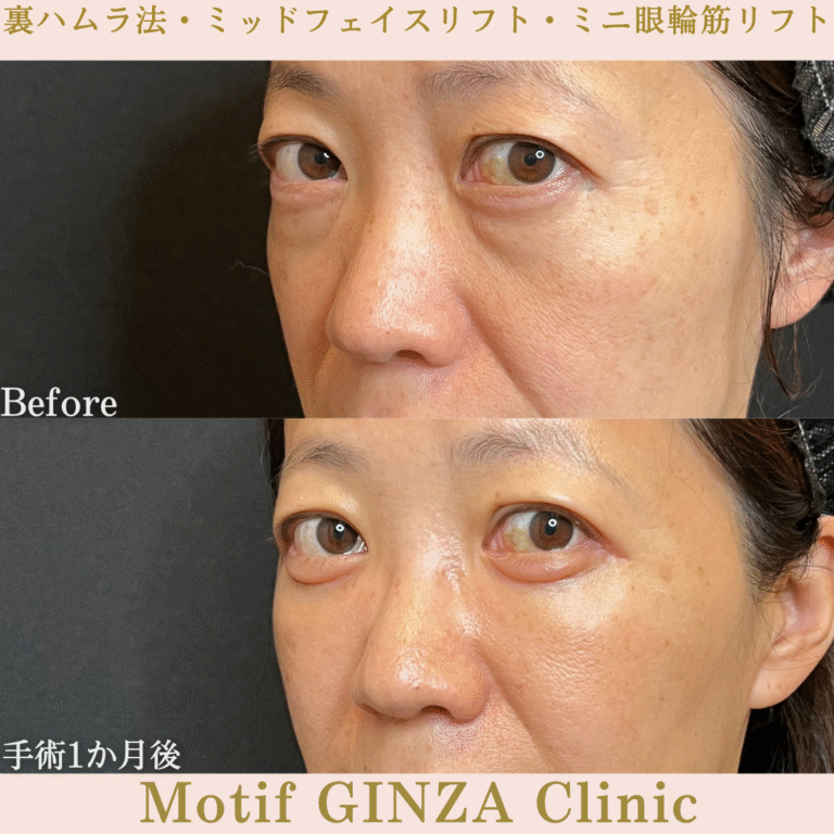 裏ハムラ法・ミッドフェイスリフト・ミニ眼輪筋リフト（手術１か月）の写真3