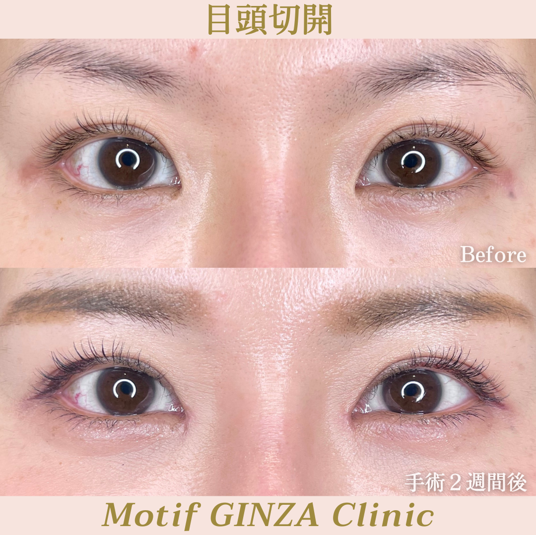 目頭切開手術（手術３ヶ月）の写真3