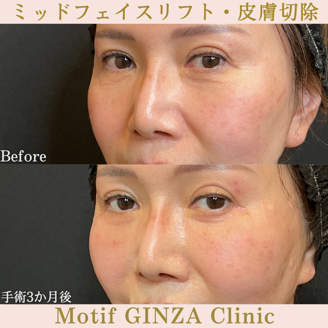 ミッドフェイスリフト・皮膚切除(手術6か月)の写真4