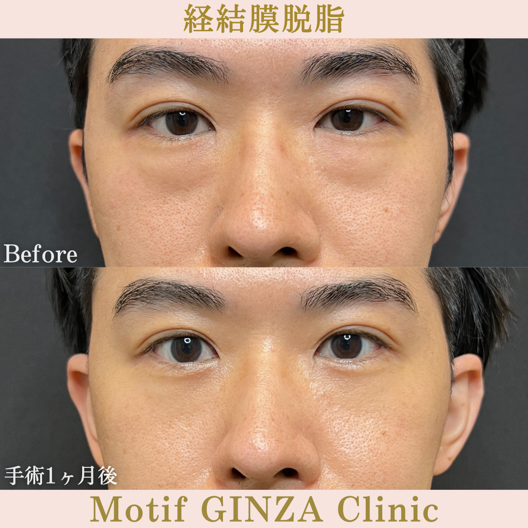 経結膜脱脂（手術１ヶ月）の写真