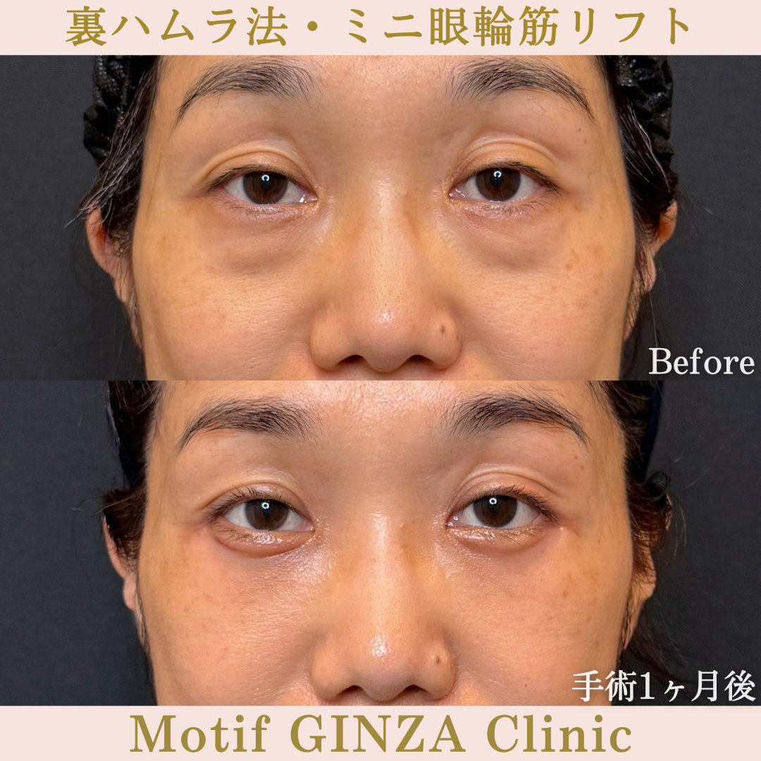 裏ハムラ法・ミニ眼輪筋リフト（手術３か月）の写真3