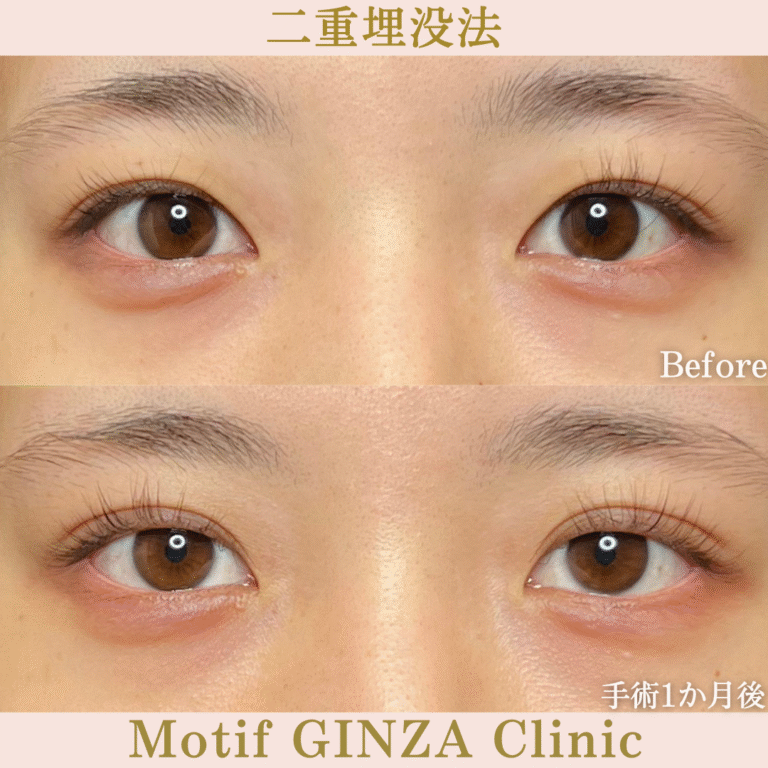 二重埋没法（手術１か月）