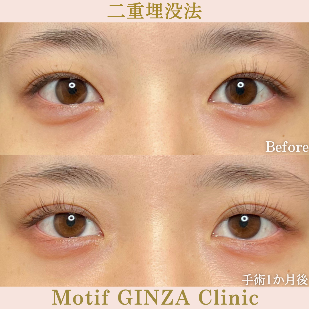 二重埋没法（手術１か月）の写真