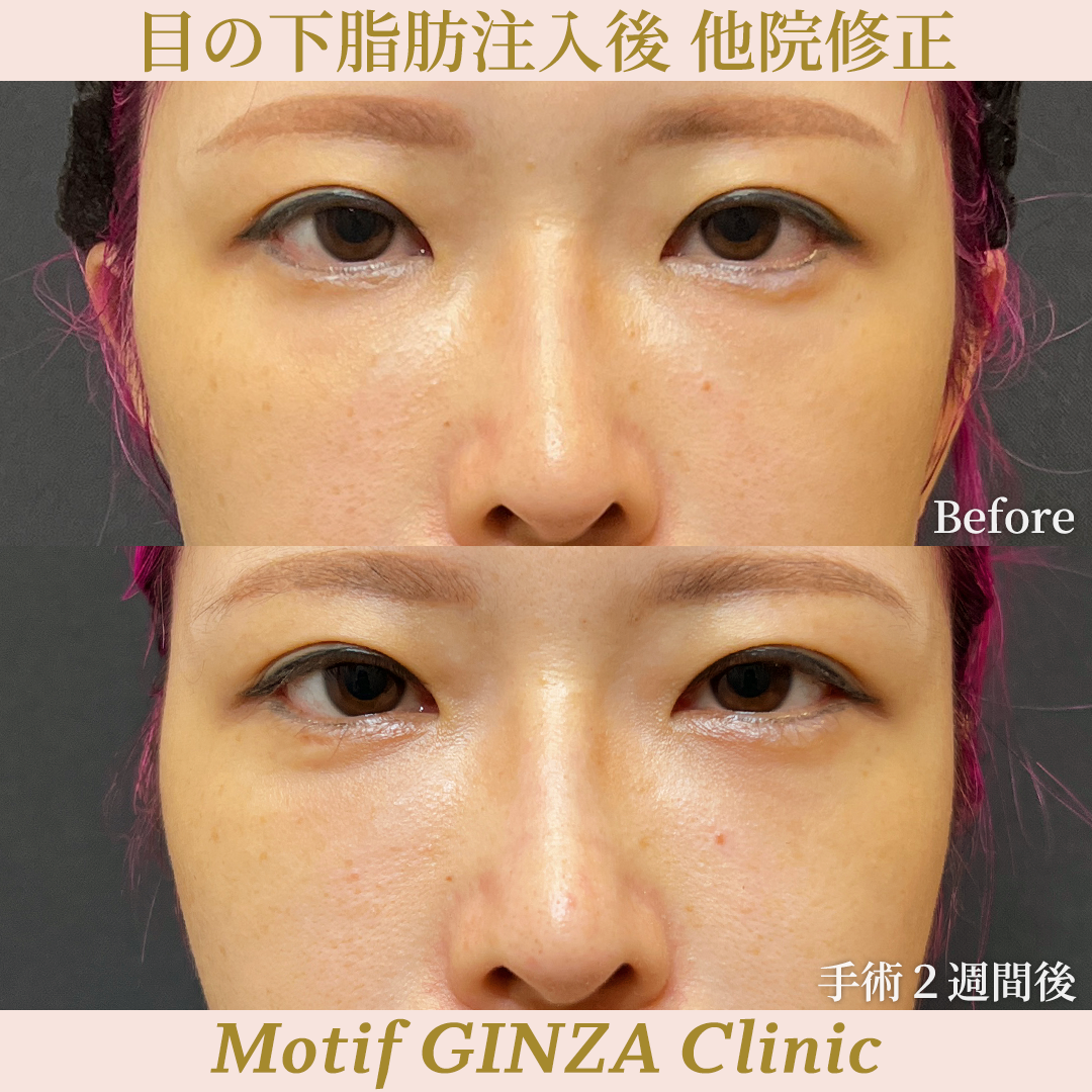 目の下脂肪注入後 他院修正（裏ハムラ法）（手術３ヶ月）の写真4