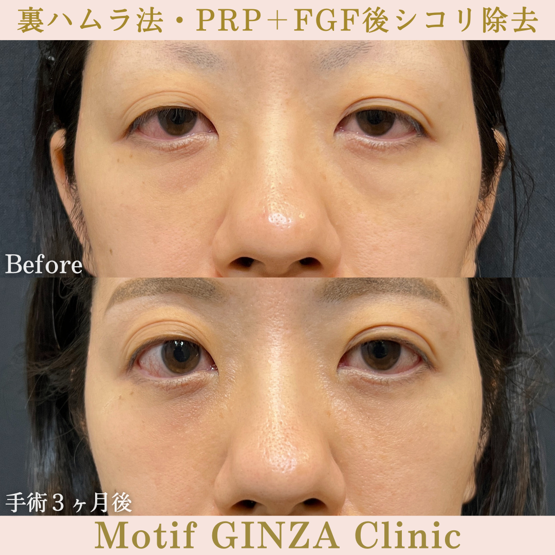 裏ハムラ法・PRP＋FGF後シコリ除去（手術３ヶ月）の写真
