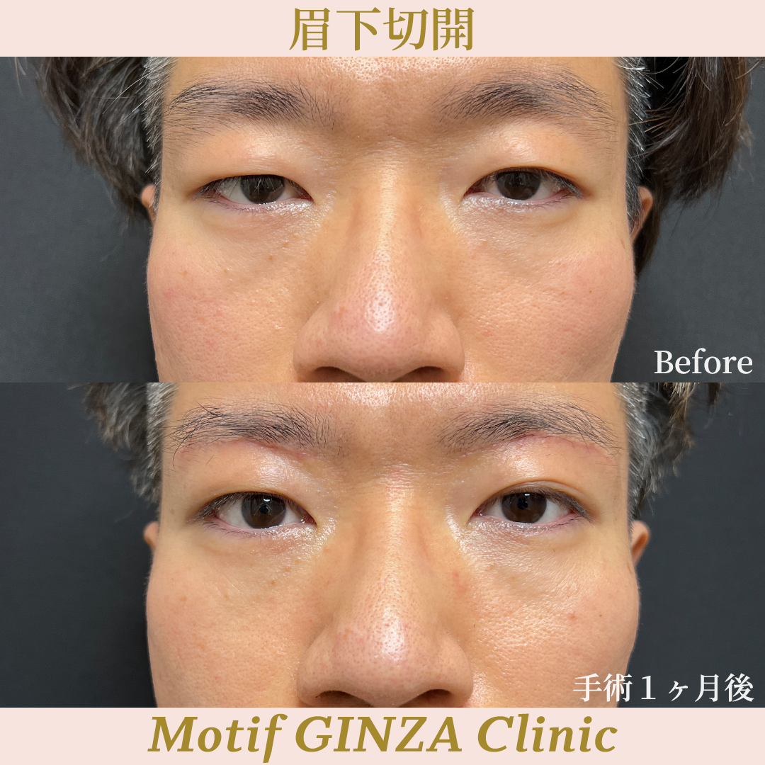眉下切開（手術１ヶ月）の写真