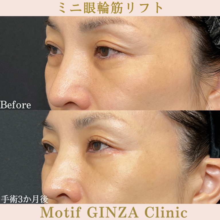 ミニ眼輪筋リフト（手術３か月）の写真2