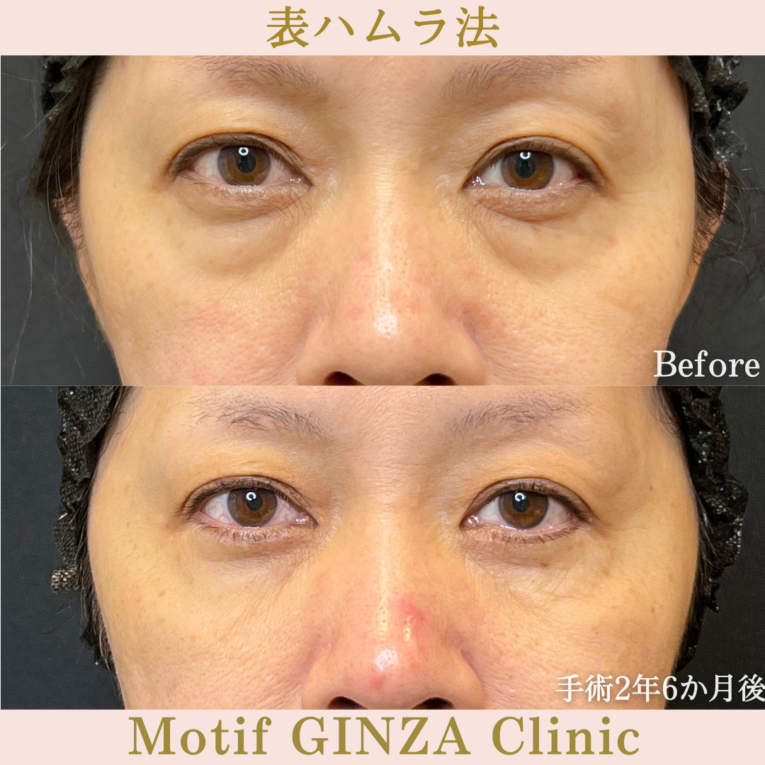 切開式下眼瞼たるみ取り（手術2年6か月）の写真