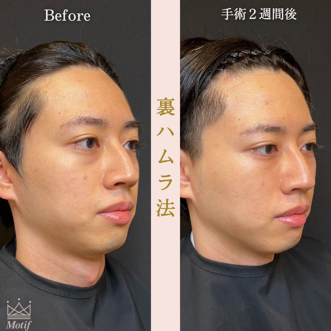 裏ハムラ法（手術３ヶ月）の写真6