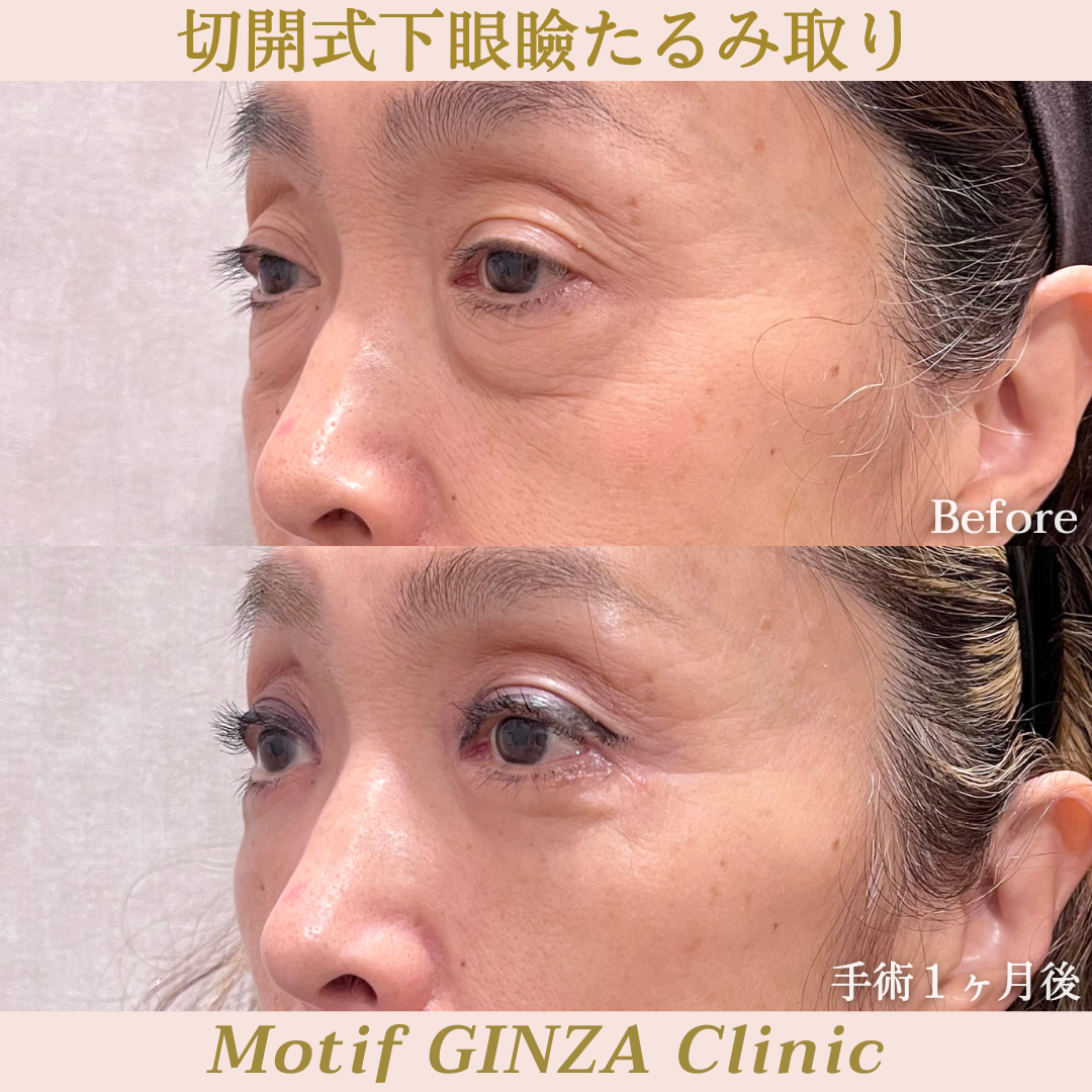 切開式下眼瞼たるみ取り(ハムラ法)(手術3ヶ月)の写真4