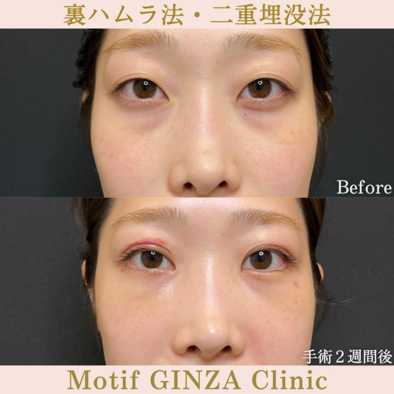 裏ハムラ法・二重埋没法(手術3か月)の写真5