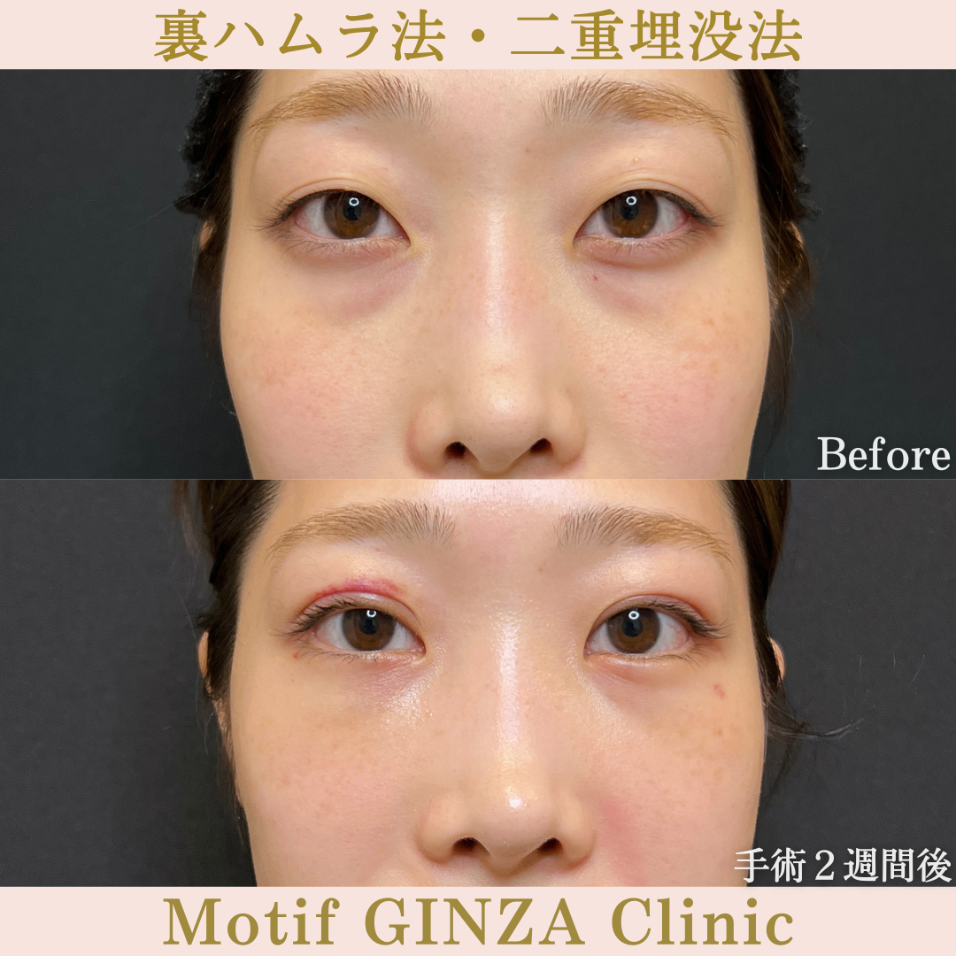 裏ハムラ法・二重埋没法(手術3か月)の写真5