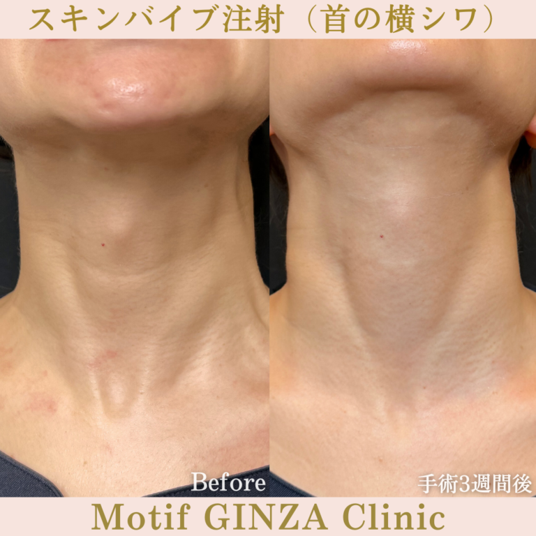スキンバイブ注射（首の横シワ）（手術3週間）