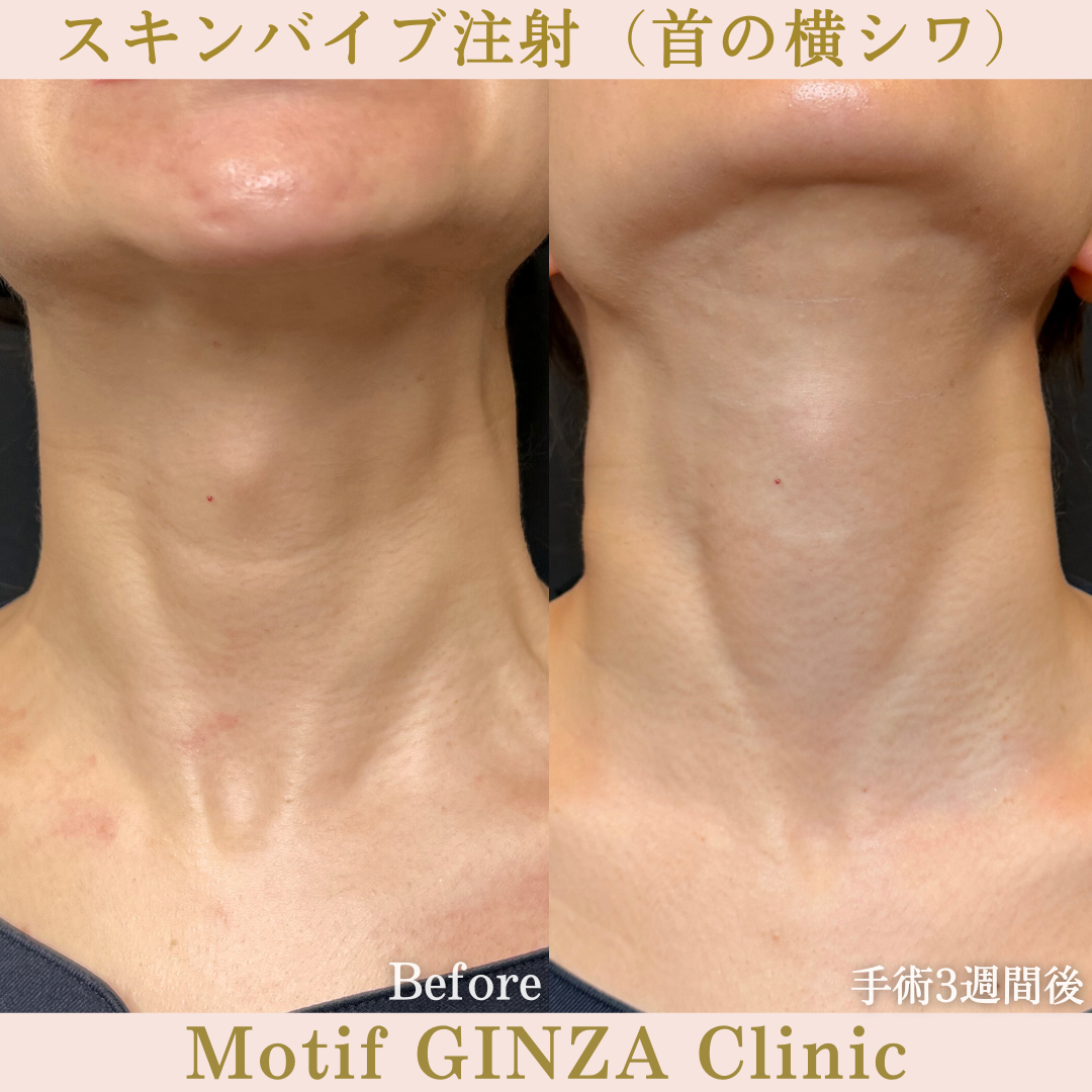 スキンバイブ注射（首の横シワ）（手術3週間）の写真