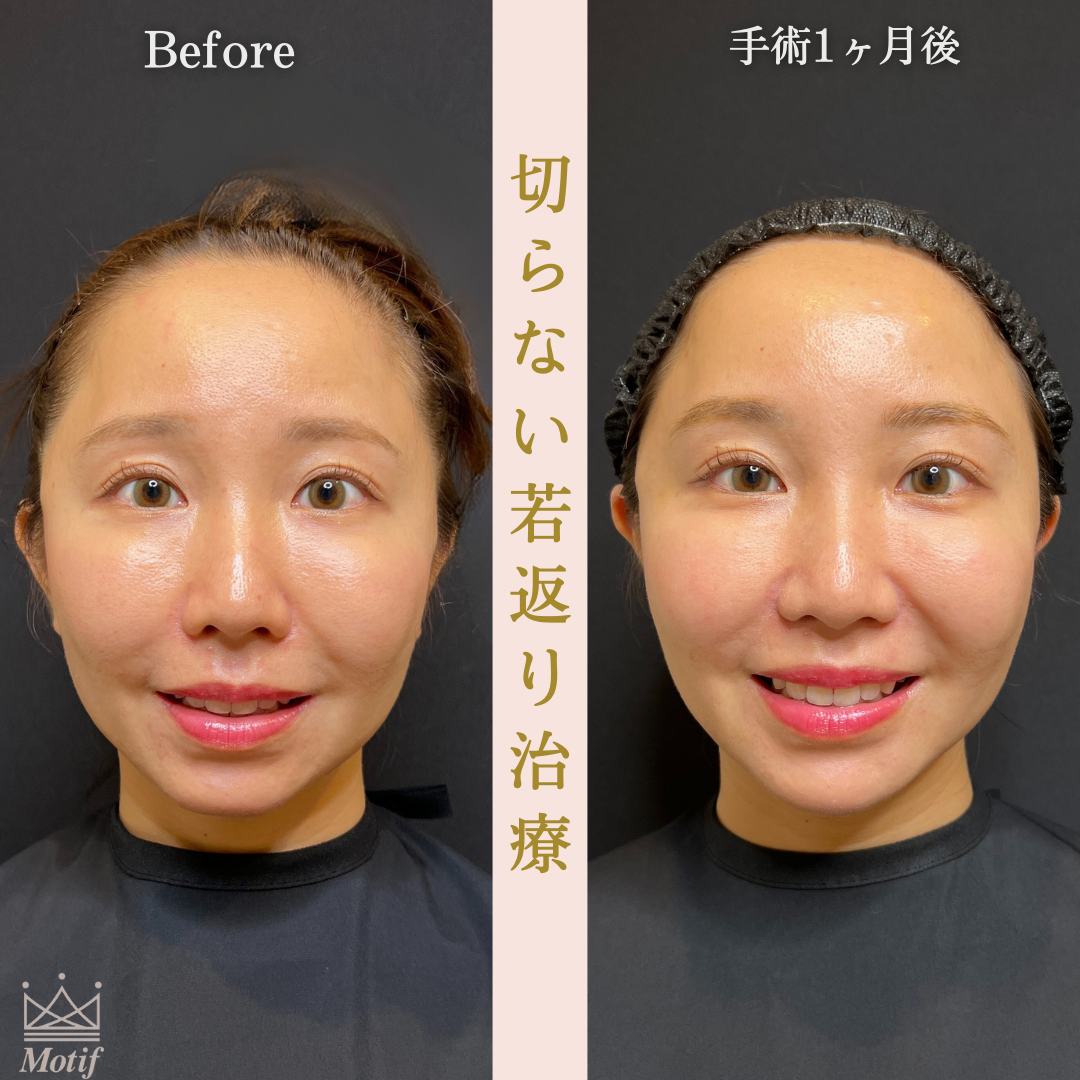 切らない若返り治療（手術１ヶ月）の写真