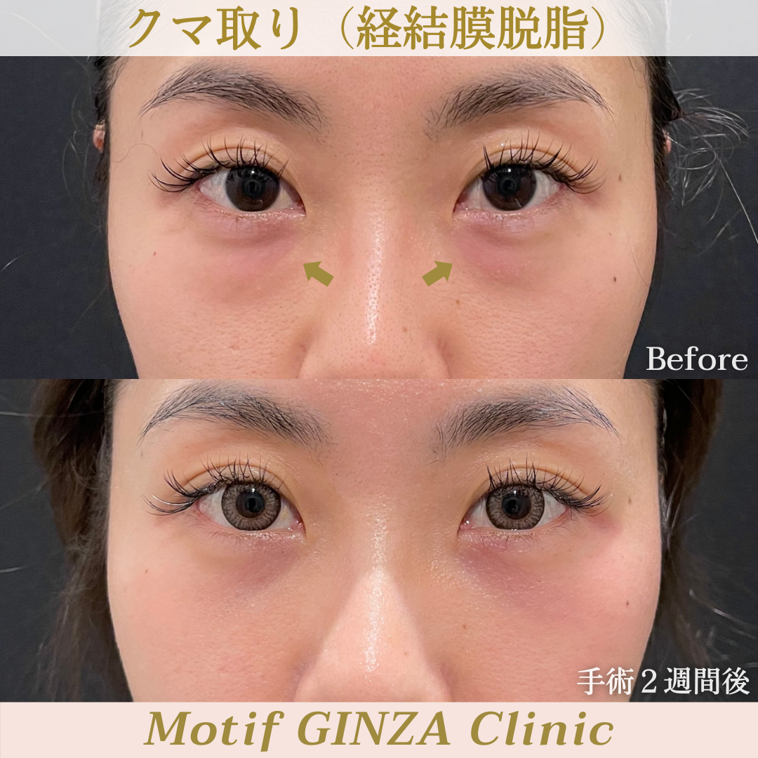 経結膜脱脂(手術1ヶ月)の写真2