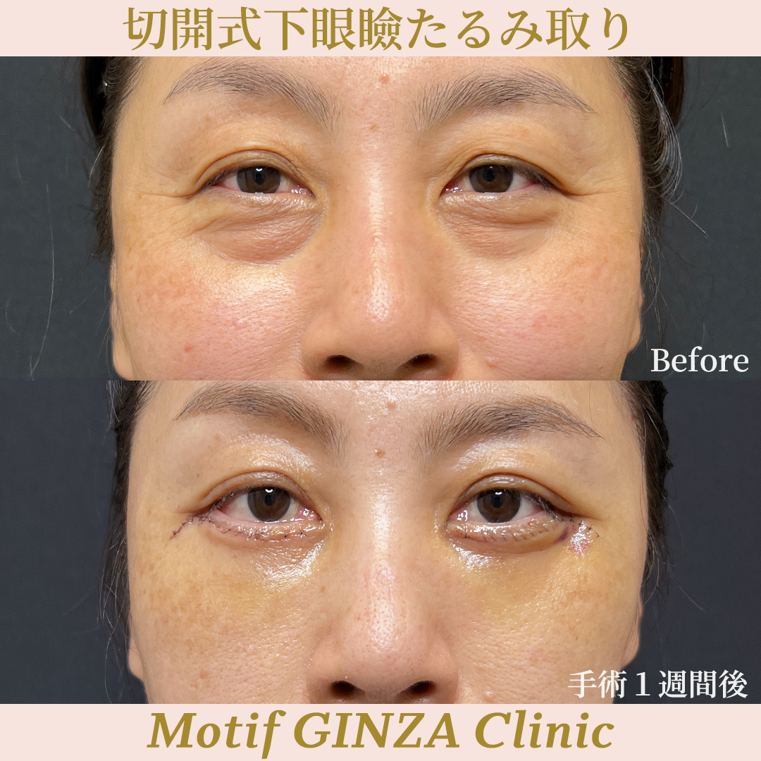 切開式下眼瞼たるみ取り（ハムラ法）（手術３ヶ月）の写真5