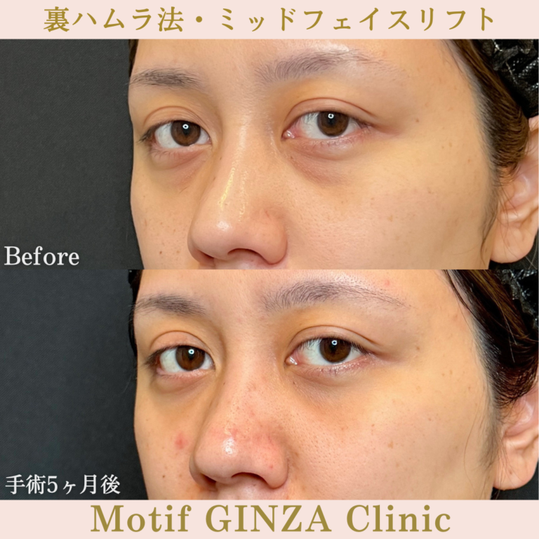 裏ハムラ法・ミッドフェイスリフト(手術5か月)の写真2