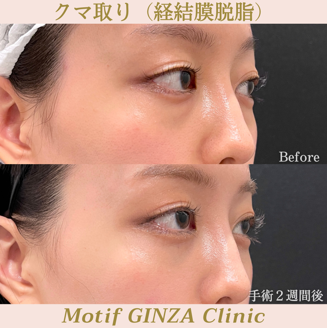 経結膜脱脂(手術1ヶ月)の写真2