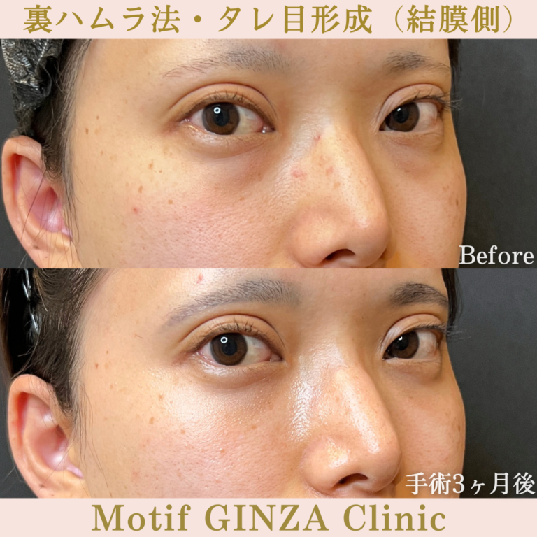 裏ハムラ法・タレ目形成（結膜側）（手術３か月）の写真2
