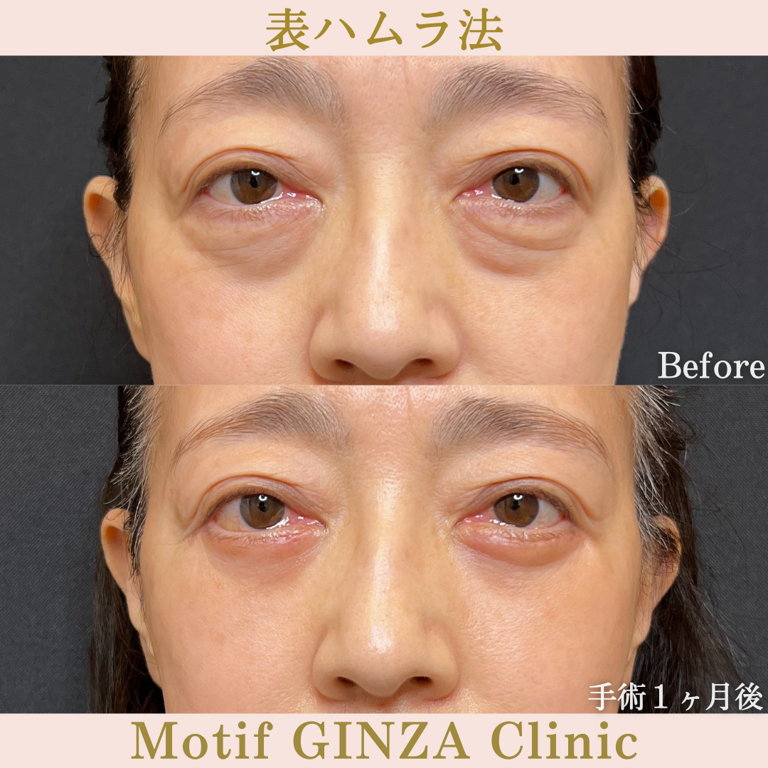切開式下眼瞼たるみ取り（手術６ヶ月）の写真3