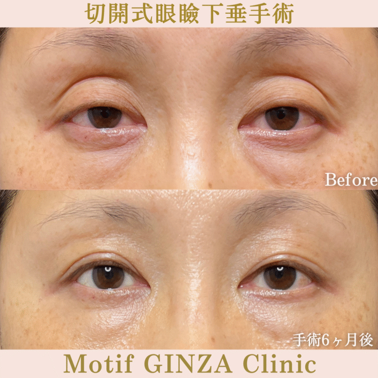 切開式眼瞼下垂手術(手術6ヶ月)
