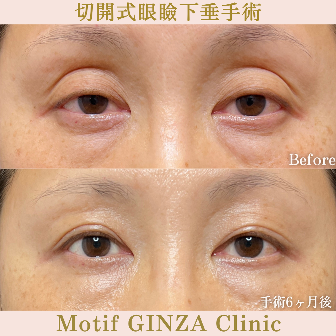 切開式眼瞼下垂手術（手術６ヶ月）の写真