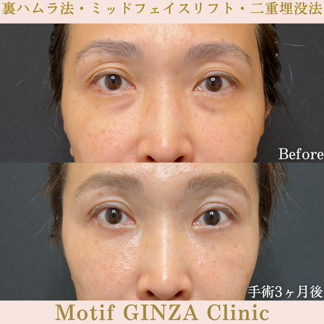 裏ハムラ法・ミッドフェイスリフト・二重埋没法（手術６ヶ月）の写真4