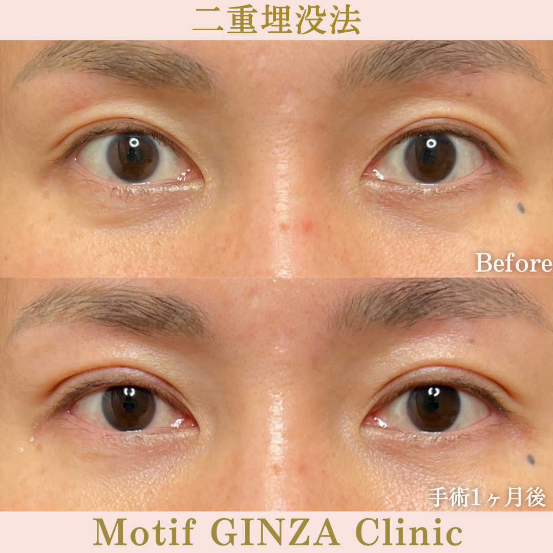二重埋没法（手術１か月）の写真