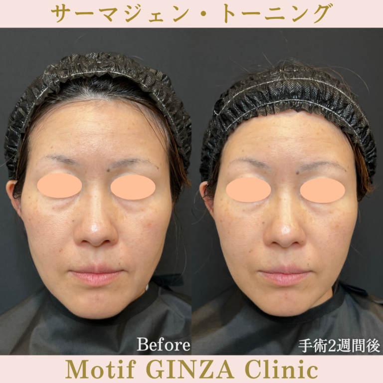 サーマジェン・トーニング(手術1か月)の写真3