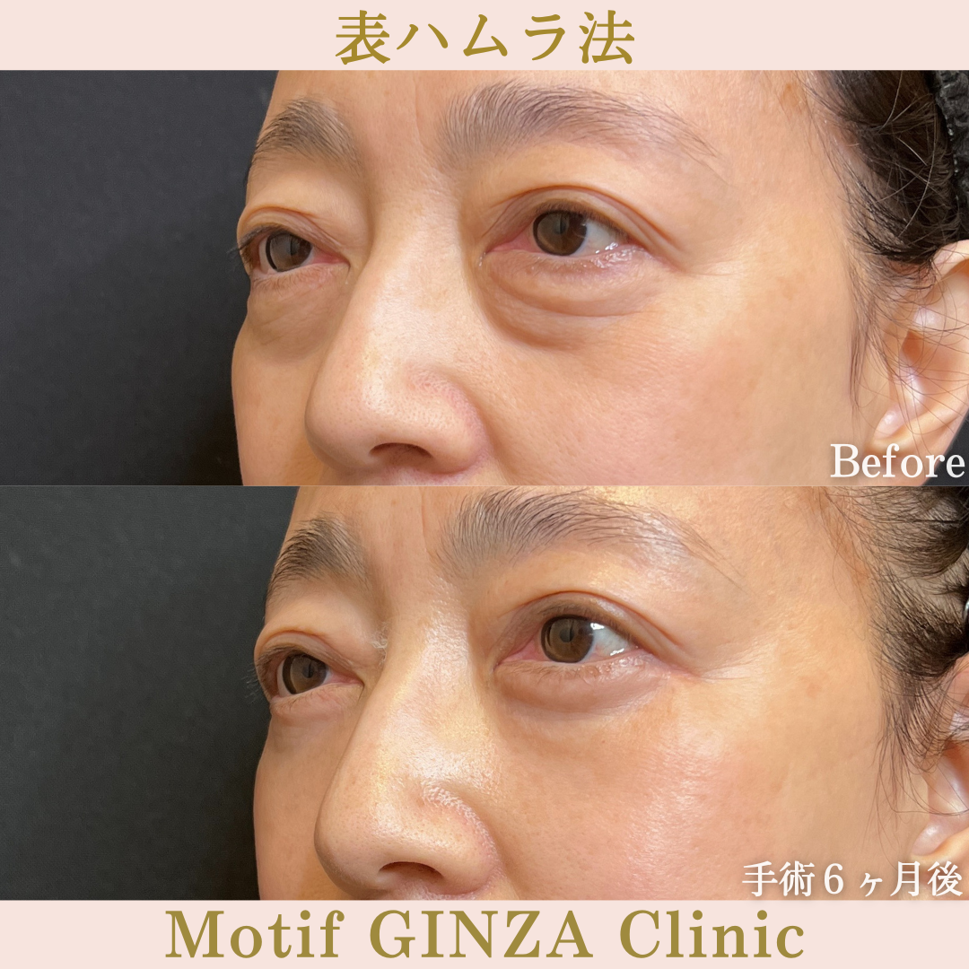切開式下眼瞼たるみ取り（手術６ヶ月）の写真2