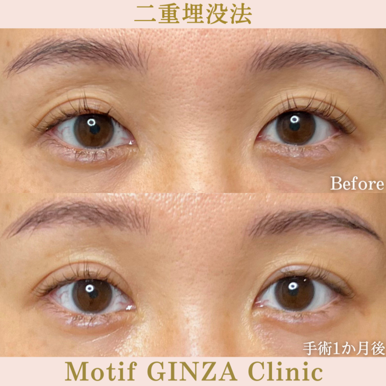 二重埋没法法（手術1か月）