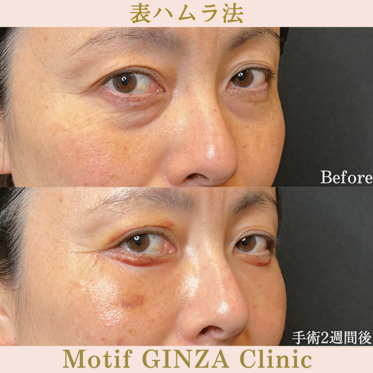 切開式下眼瞼たるみ取り（手術３か月）の写真6