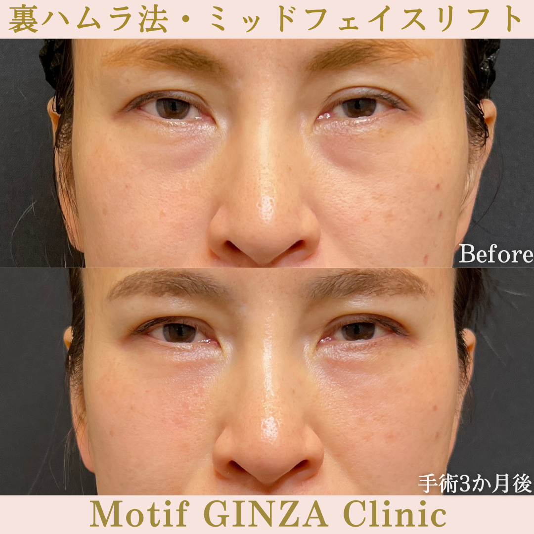 裏ハムラ法・ミッドフェイスリフト（手術１年）の写真3
